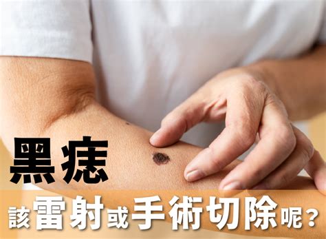 陰莖黑痣|手術切除還是其他方法？陰莖黑痣、陰囊和包皮痣的處理方式